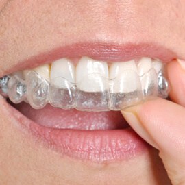 clear-aligners-cropped Home