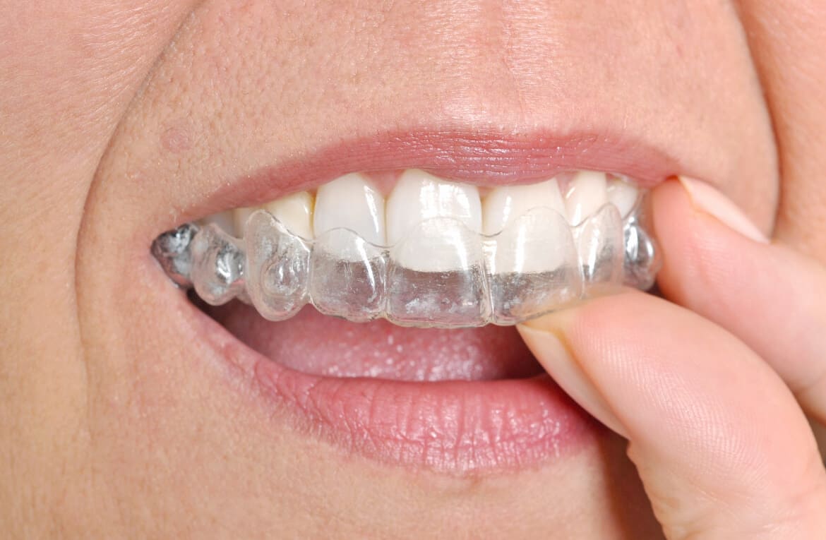 clear-aligners-reduced INVISALIGN
