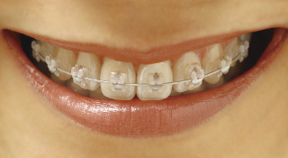 Clippy-C-2_cropped TRADITIONAL BRACES